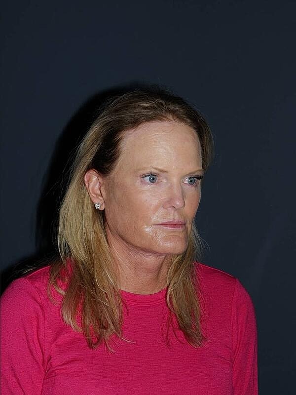 Blepharoplasty Before & After