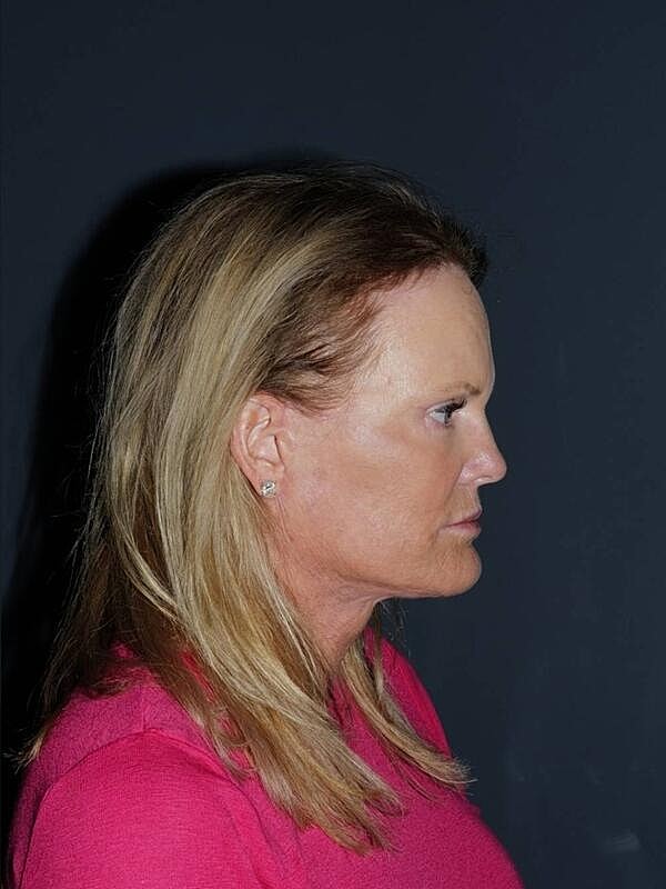 Blepharoplasty Before & After