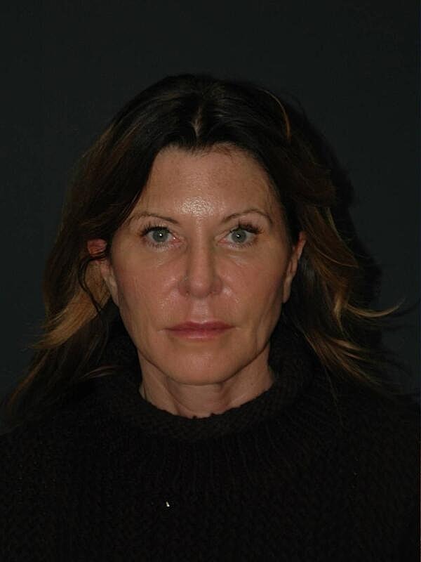 Blepharoplasty Before & After