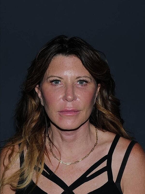 Blepharoplasty Before & After