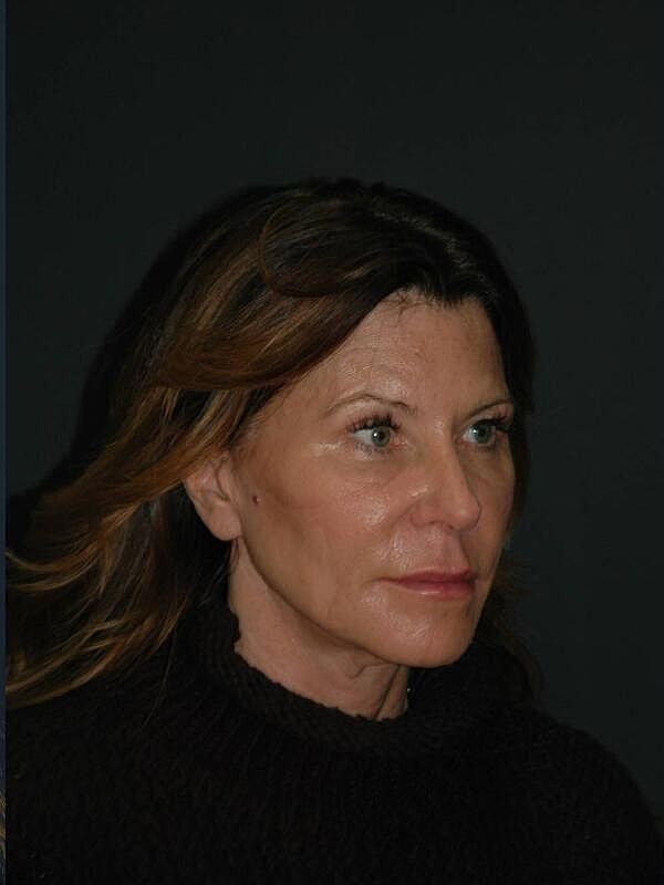 Blepharoplasty Before & After