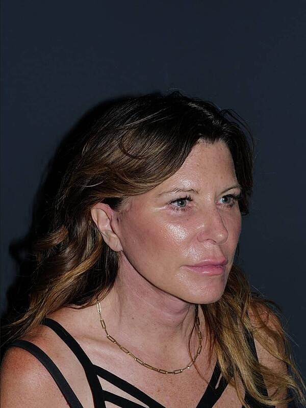 Blepharoplasty Before & After