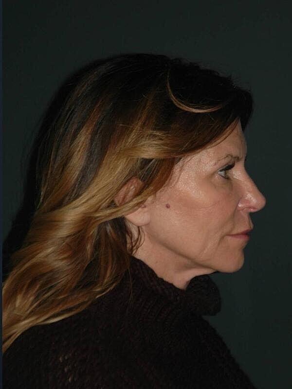 Blepharoplasty Before & After