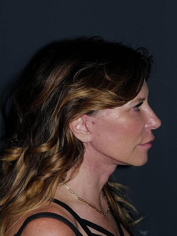 Blepharoplasty Before & After