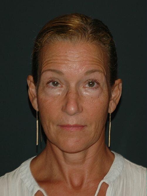 Blepharoplasty Before & After