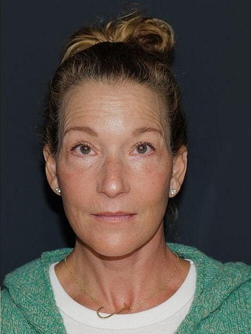 Blepharoplasty Before & After