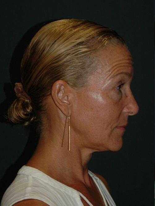 Blepharoplasty Before & After