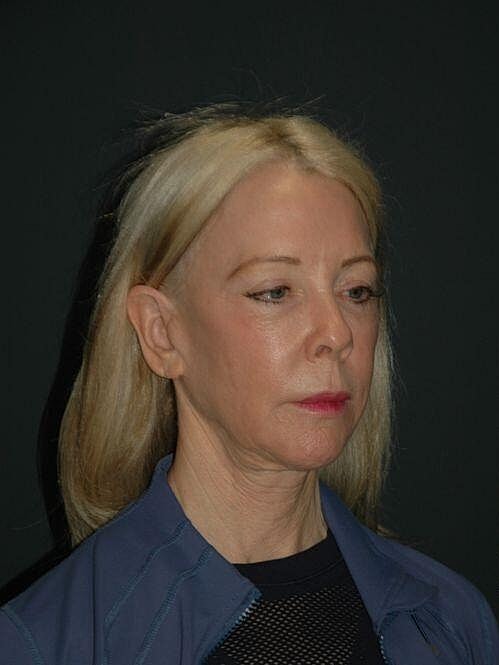 Blepharoplasty Before & After