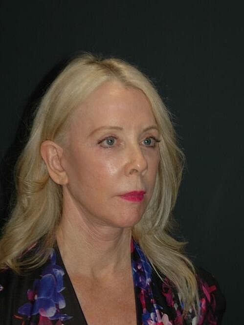 Blepharoplasty Before & After