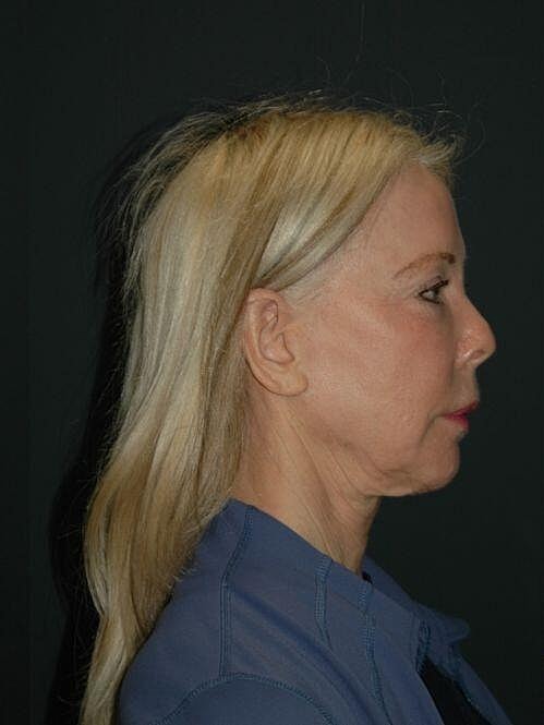 Blepharoplasty Before & After