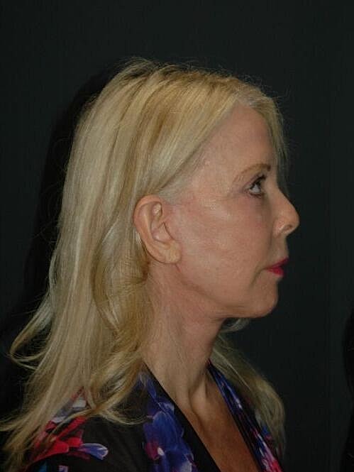 Blepharoplasty Before & After