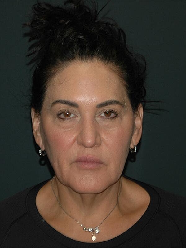 Blepharoplasty Before & After