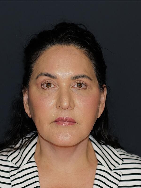 Blepharoplasty Before & After