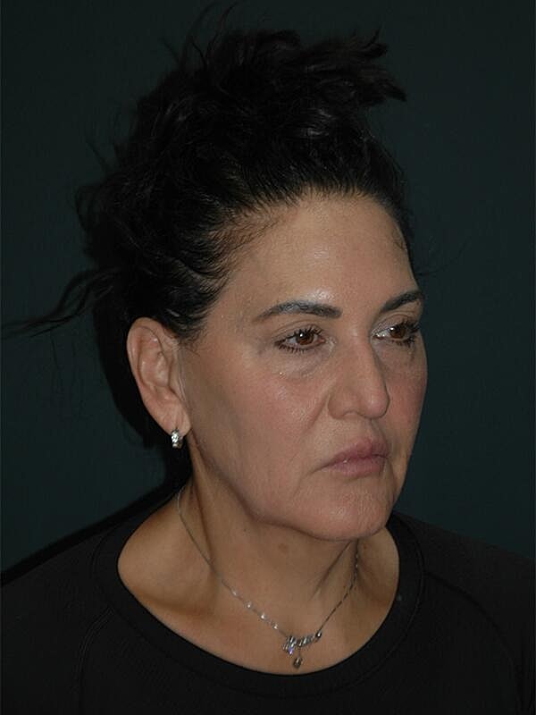 Blepharoplasty Before & After