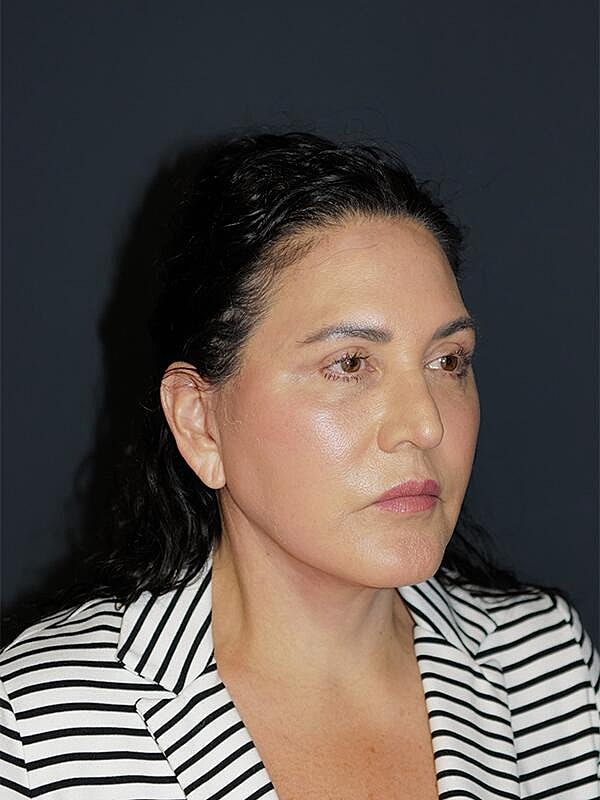 Blepharoplasty Before & After