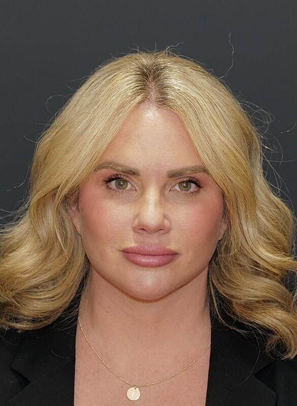 Blepharoplasty Before & After
