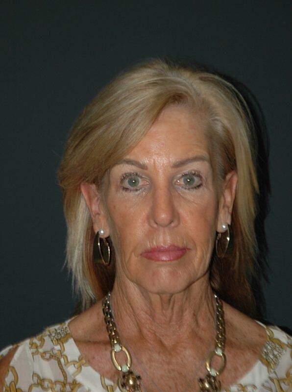 Blepharoplasty Before & After