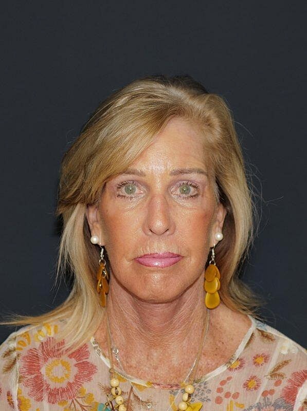 Blepharoplasty Before & After