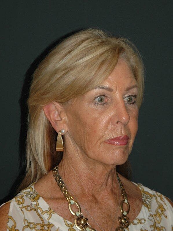 Blepharoplasty Before & After