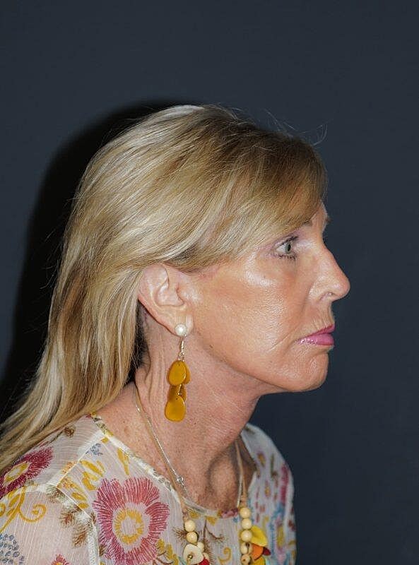 Blepharoplasty Before & After