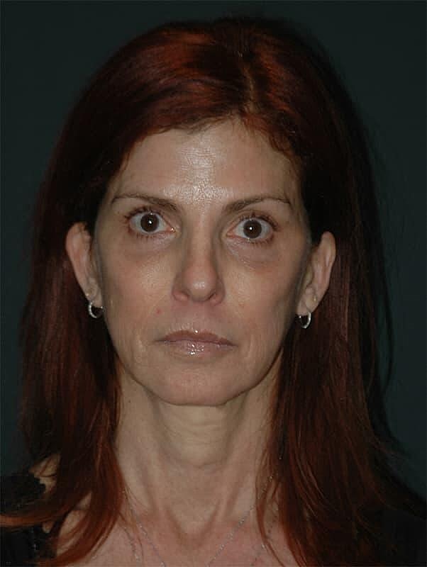 Blepharoplasty Before & After