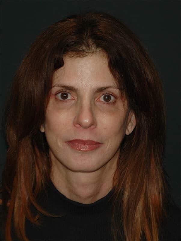 Blepharoplasty Before & After