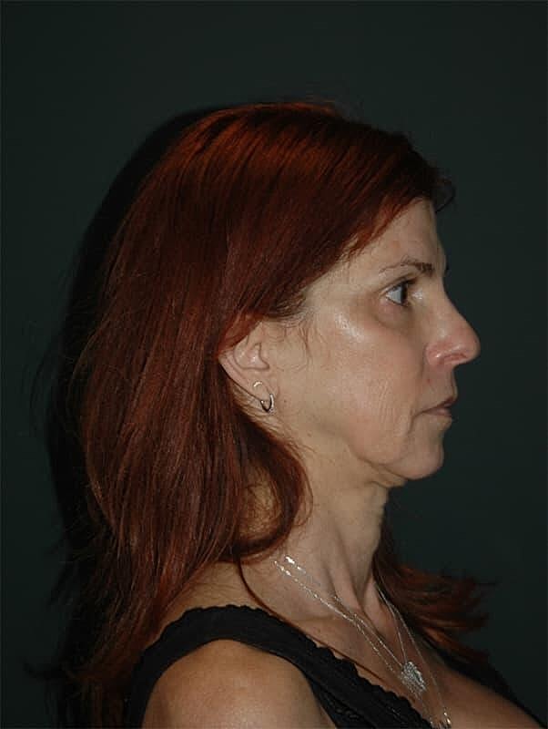 Blepharoplasty Before & After