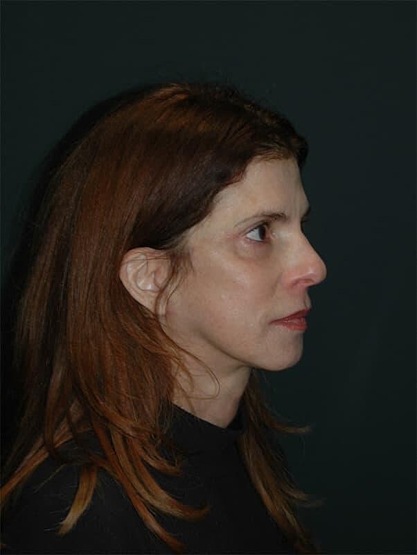 Blepharoplasty Before & After