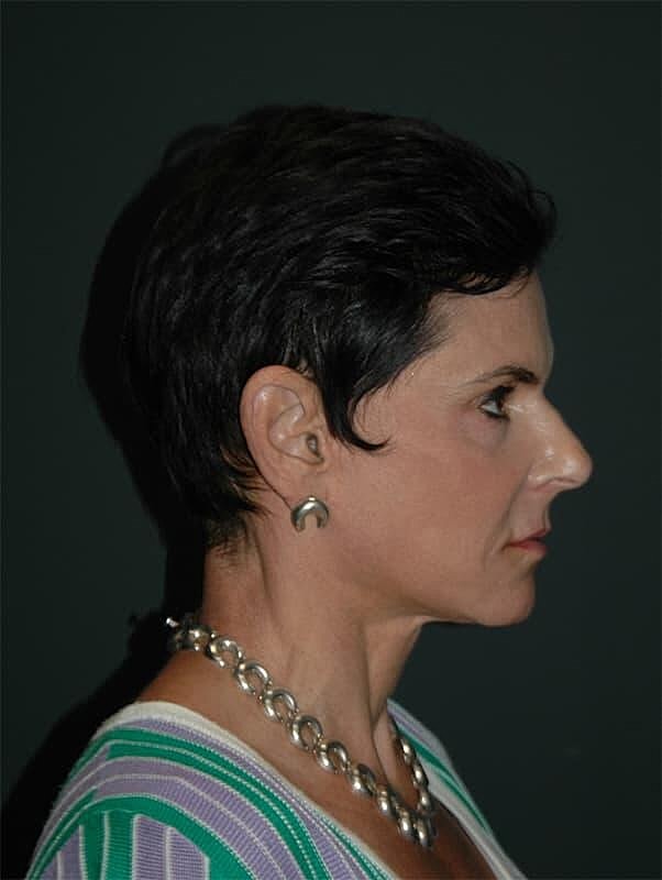 Blepharoplasty Before & After