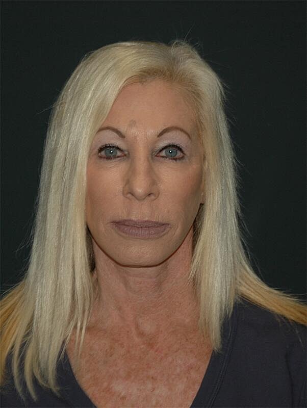 Blepharoplasty Before & After