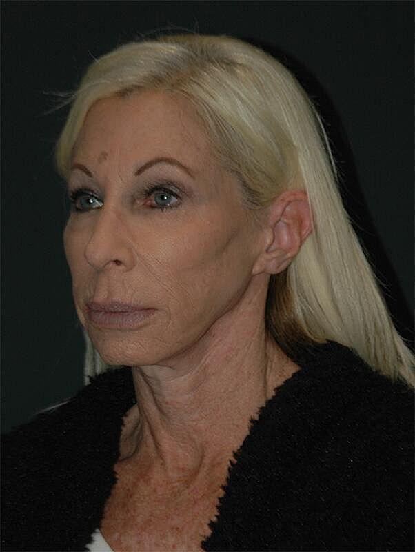 Blepharoplasty Before & After
