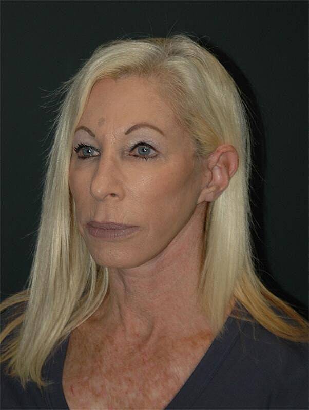 Blepharoplasty Before & After