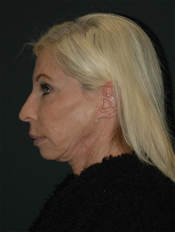 Blepharoplasty Before & After