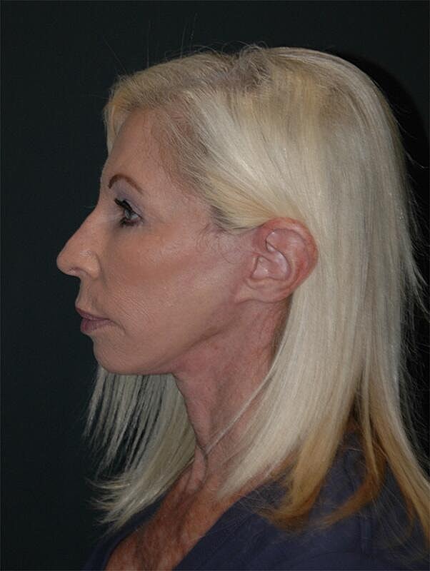 Blepharoplasty Before & After