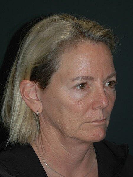 Blepharoplasty Before & After
