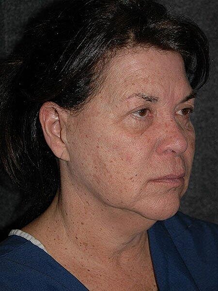 Blepharoplasty Before & After
