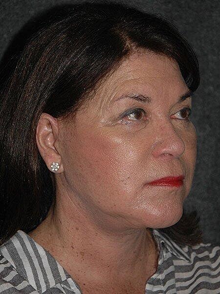 Blepharoplasty Before & After