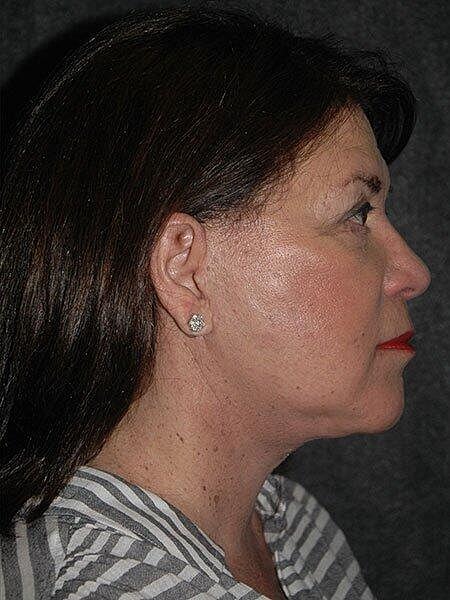 Blepharoplasty Before & After