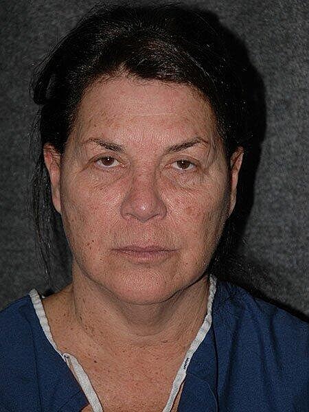 Blepharoplasty Before & After