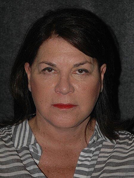 Blepharoplasty Before & After