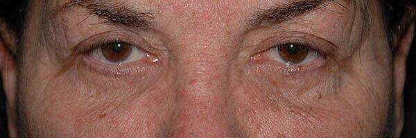 Blepharoplasty Before & After