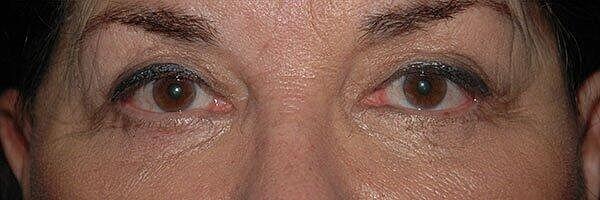 Blepharoplasty Before & After