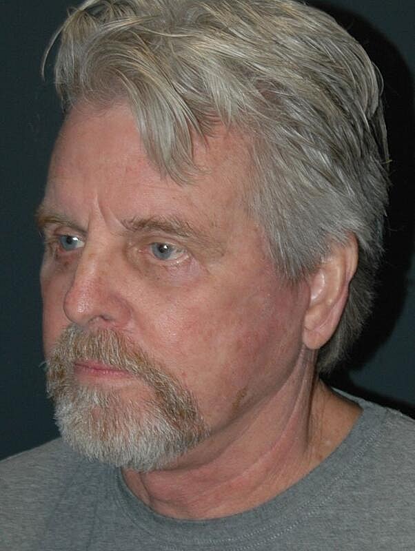 Blepharoplasty Before & After