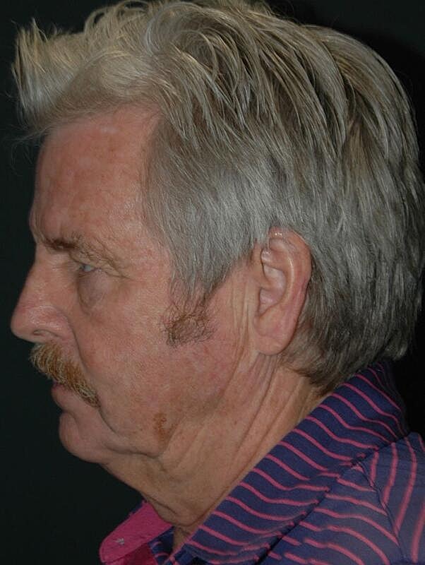 Blepharoplasty Before & After