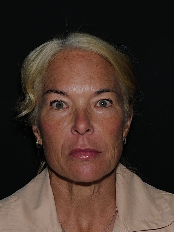 Blepharoplasty Before & After