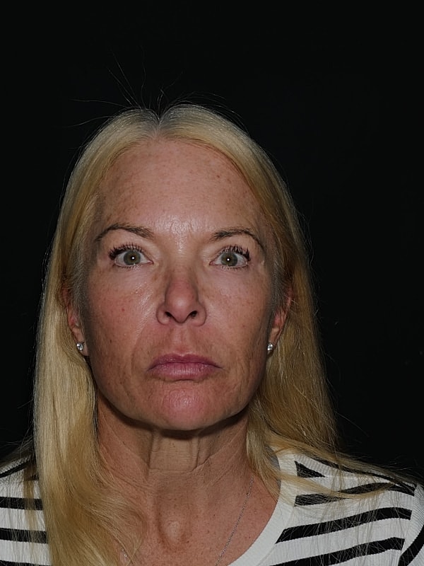 Blepharoplasty Before & After