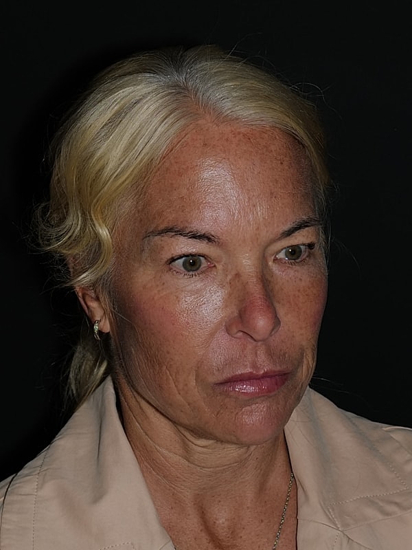 Blepharoplasty Before & After