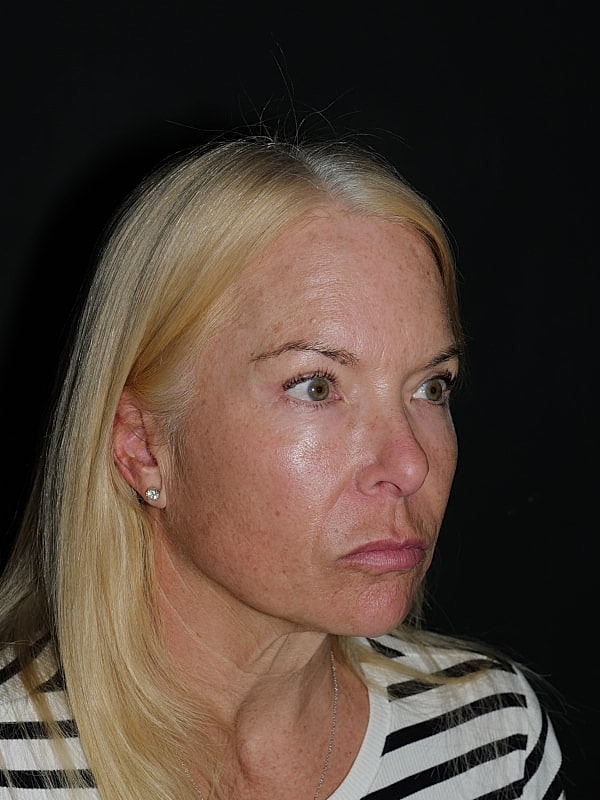 Blepharoplasty Before & After