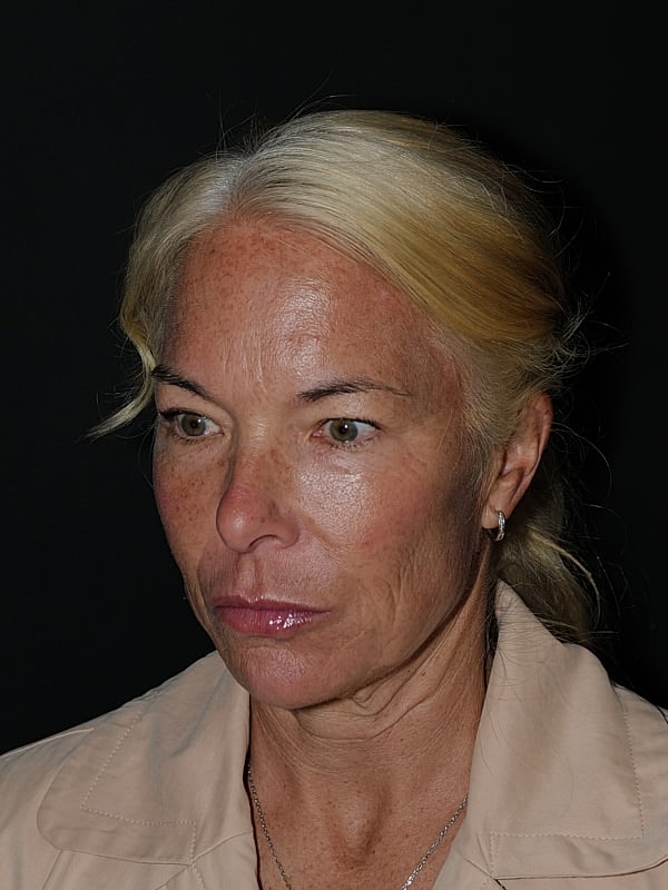 Blepharoplasty Before & After
