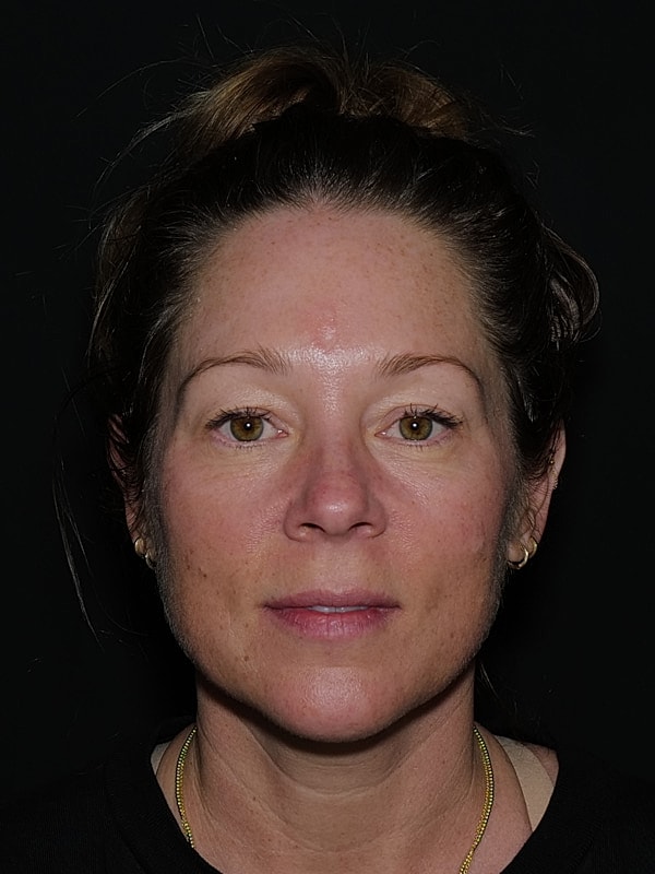 Blepharoplasty Before & After